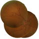 Siegrist Streaks and Hypertensive Choroidopathy