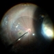 Familial Exudative Vitreoretinopathy (FEVR) Familial Exudative Vitreoretinopathy (FEVR)