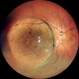 Choroidal Mass Choroidal Mass