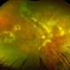CMV Retinitis with Shallow RD CMV Retinitis with Shallow RD