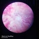 Florid Disc Edema Hemorrhage