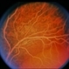Hyperlipidemia