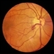 Preretinal Vascular Loop Preretinal Vascular Loop