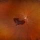 Pre-Retinal Hemorrhage Pre-Retinal Hemorrhage