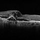 Neovascular AMD with Ring Shaped lesions