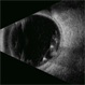 IOL in Vitreous Cavity