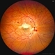 Combined Central Retinal Vein Occlusion with Branch Retinal Artery Occlusion Combined Central Retinal Vein Occlusion with Branch Retinal Artery Occlusion