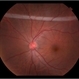 Retinal Fold Retinal Fold