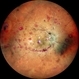 Anaemic Retinopathy Anaemic Retinopathy