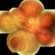 Peripheral Retinoschisis Peripheral Retinoschisis
