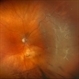 Retinal Detachment with Multiple Breaks Retinal Detachment with Multiple Breaks