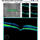 Focal Choroidal Excavation- An OCT Diagnosis Focal Choroidal Excavation- An OCT Diagnosis