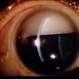 Inverted Hypopyon - Silicon Oil Complication Inverted Hypopyon - Silicon Oil Complication