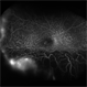 Uveal Effusion Syndrome Uveal Effusion Syndrome