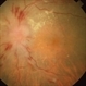Malignant Hypertension Malignant Hypertension