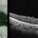 Unilateral Subretinal Toxocara Granuloma Unilateral Subretinal Toxocara Granuloma