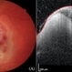 Choroidal MRSA Abscess