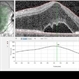 Possible Uveitis or RP Variant Possible Uveitis or RP Variant