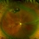 New Retinal Detachment 6w s/p RD repair New Retinal Detachment 6w s/p RD repair