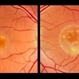 Dystrophy Best (Dystrophy, Macular Viteliforme) Dystrophy Best (Dystrophy, Macular Viteliforme)