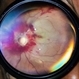 Optic disc avulsion Optic disc avulsion