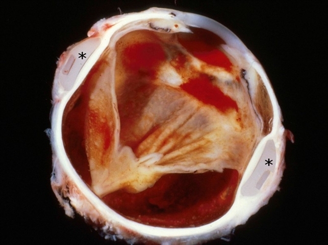 Vogt-Koyanagu-Harada (VKH) Disease - Retina Image Bank