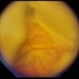 Superchoroid Hemorrhage Superchoroid Hemorrhage