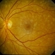 Stargardt’s Disease