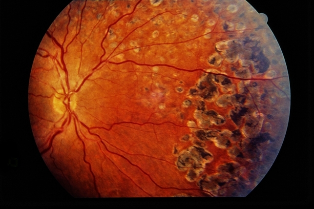 Vitreous hemorrhage retinal retina eye macula treatment Sickle Cell Neovascularization and Vitreous Hemorrhage - Retina Image Bank