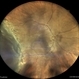RETINAL DETACHMENT STATUS POST BARRAGE LASER FOR HORSE SHOE TEAR RETINAL DETACHMENT STATUS POST BARRAGE LASER FOR HORSE SHOE TEAR