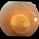 Heredomacular Degeneration