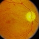 Hypertensive Retinopathy