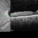 Posterior Placoid Chorioretinitis Posterior Placoid Chorioretinitis