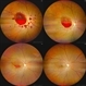 Valsalva Retinopathy Valsalva Retinopathy