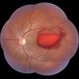 Subhyaloid Haemorrhage - Valsalva Retinopathy Subhyaloid Haemorrhage - Valsalva Retinopathy