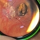 Ocular toxoplasmosis Ocular toxoplasmosis