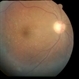 Preretinal Triamcinolone Crystals Years after IVT Preretinal Triamcinolone Crystals Years after IVT