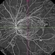 Proliferative Diabetic Retinopathy Proliferative Diabetic Retinopathy