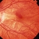 Macular Hemorrhage Macular Hemorrhage