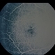Ring 17 Chromosome Ring 17 Chromosome