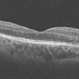 Persistence of Sub Retinal Fluid Post Retinal Reattachment Surgery Persistence of Sub Retinal Fluid Post Retinal Reattachment Surgery