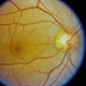 Central Serous Chorioretinopathy (CSR)