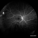 Telangiectasia 4 Telangiectasia 4