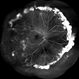 FFA in a Case of Retinoschisis With Fluid