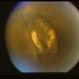 Chronic Intraocular Foreign Body With Siderosis Chronic Intraocular Foreign Body With Siderosis