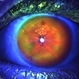 Iris Bombe