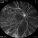 Combined Central Retinal Artery and Vein Occlusion Combined Central Retinal Artery and Vein Occlusion