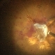 Endstage Diabetic Traction Retinal Detachment Endstage Diabetic Traction Retinal Detachment