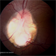 Optic Disc Coloboma