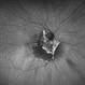RPE Rip s/p Brachytherapy for Malignant Melanoma RPE Rip s/p Brachytherapy for Malignant Melanoma